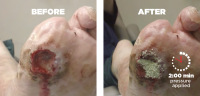 Diabetic Foot Ulcer on Coumadin®, Plavix®, and Aspirin